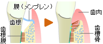>組織再生誘導法(GTR法)