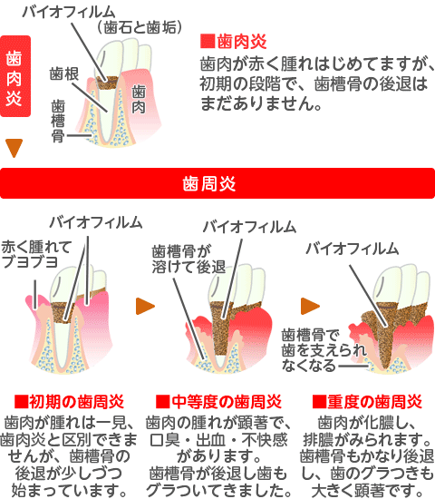 歯周病の進行