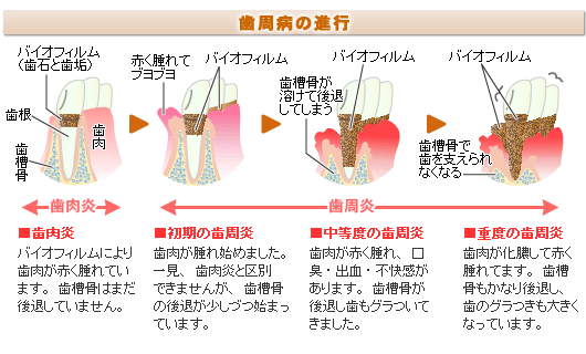 歯周病の進行