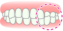 交叉咬合(こうさこうごう)